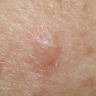 melanotic melanoma About Melanoma